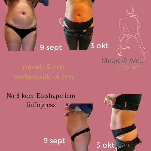 Voor en na: 8 duo-sessies: navel −5 cm, onderbuik −4 cm