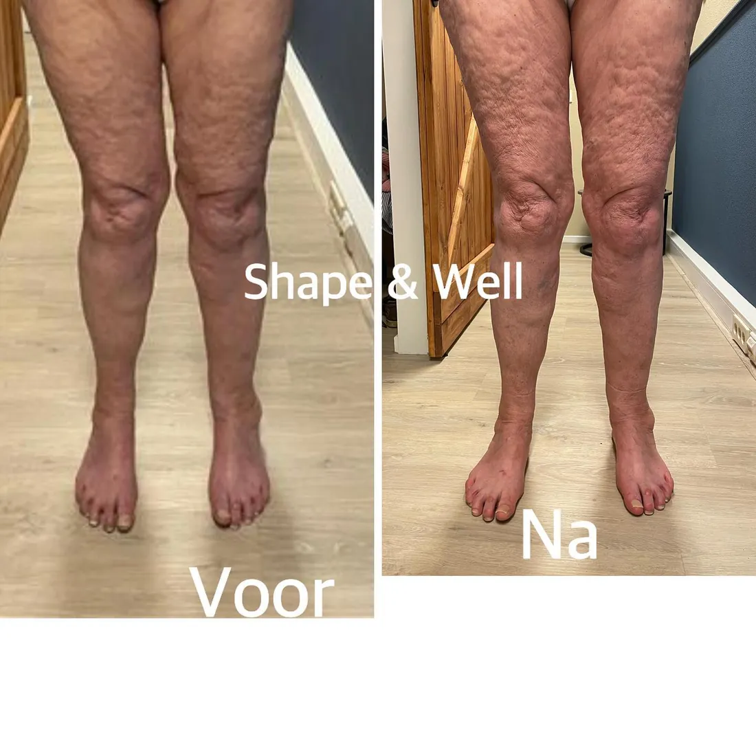 Voor en na: Linfopress, benen na 3 behandelingen